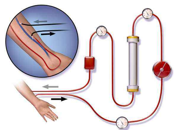 血液透析器端蓋專用塑料，你找對生產(chǎn)廠家了嗎？